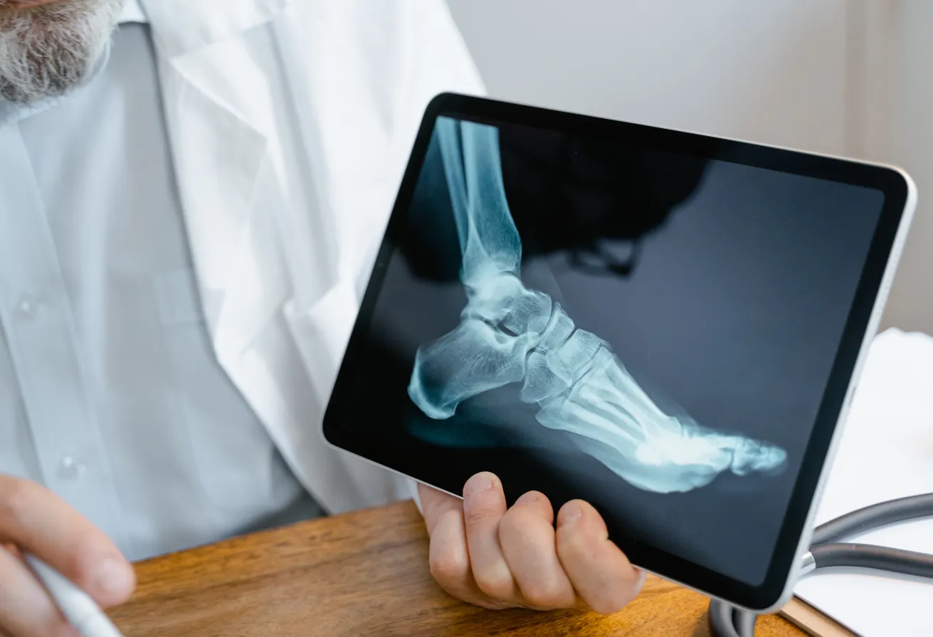 What bones teach us about how to eliminate leprosy