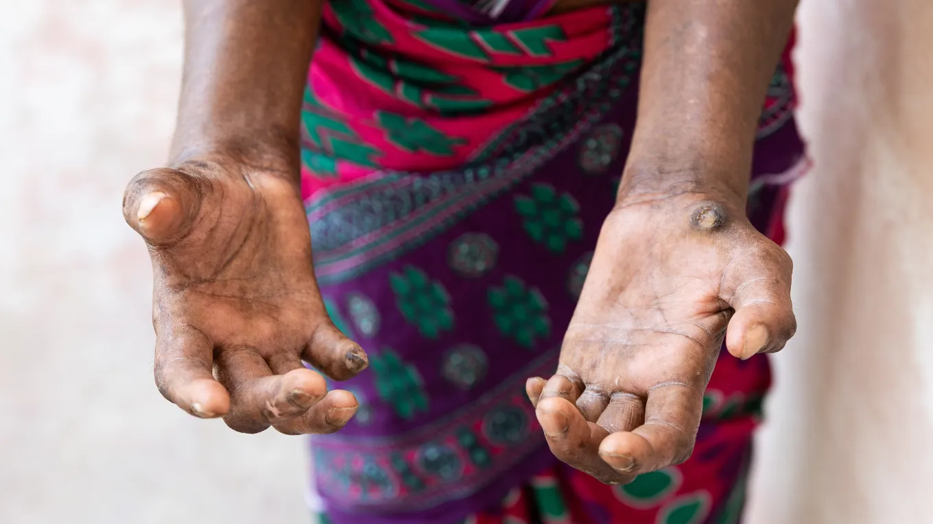 Dhwani lived with undiagnosed leprosy for 15 years.