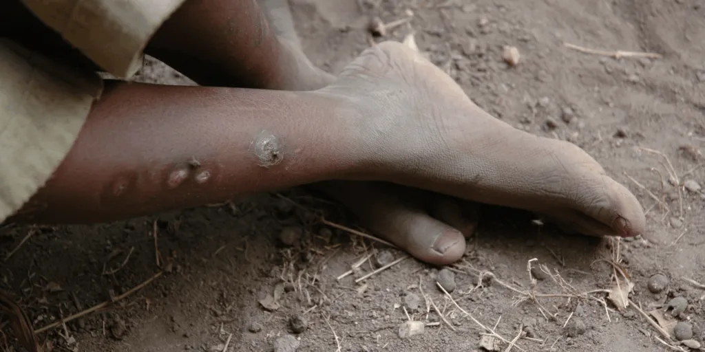 Bare feet at risk of injury in areas where leprosy affects nerve sensation