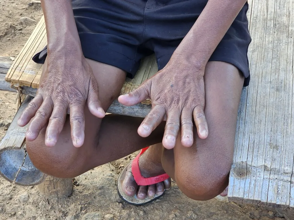 Leprosy has caused severe nerve damage to Maria's hands and feet. Her fingers are numb, making every swing of an axe dangerous.