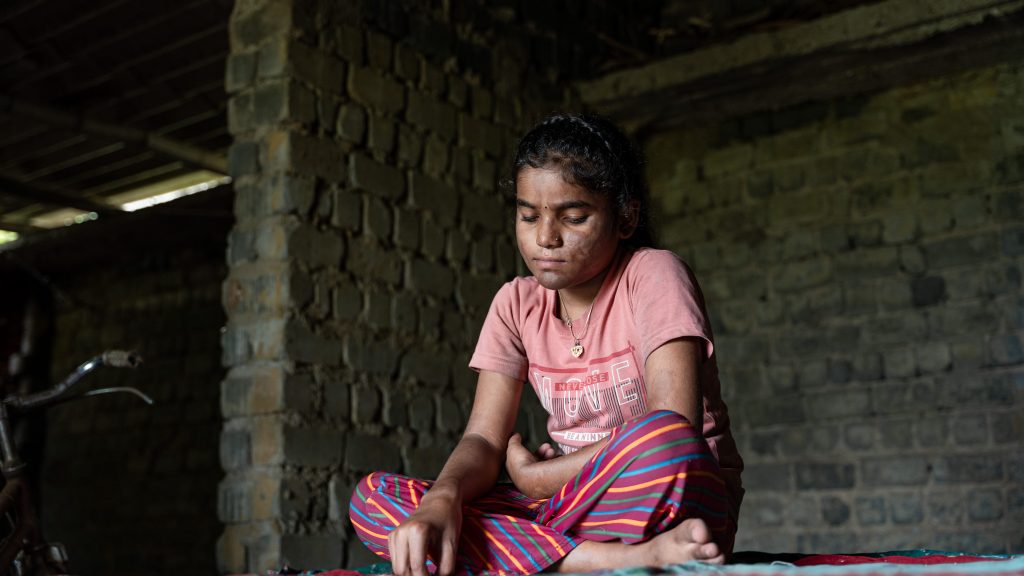 Child excluded from education because of leprosy stigma.