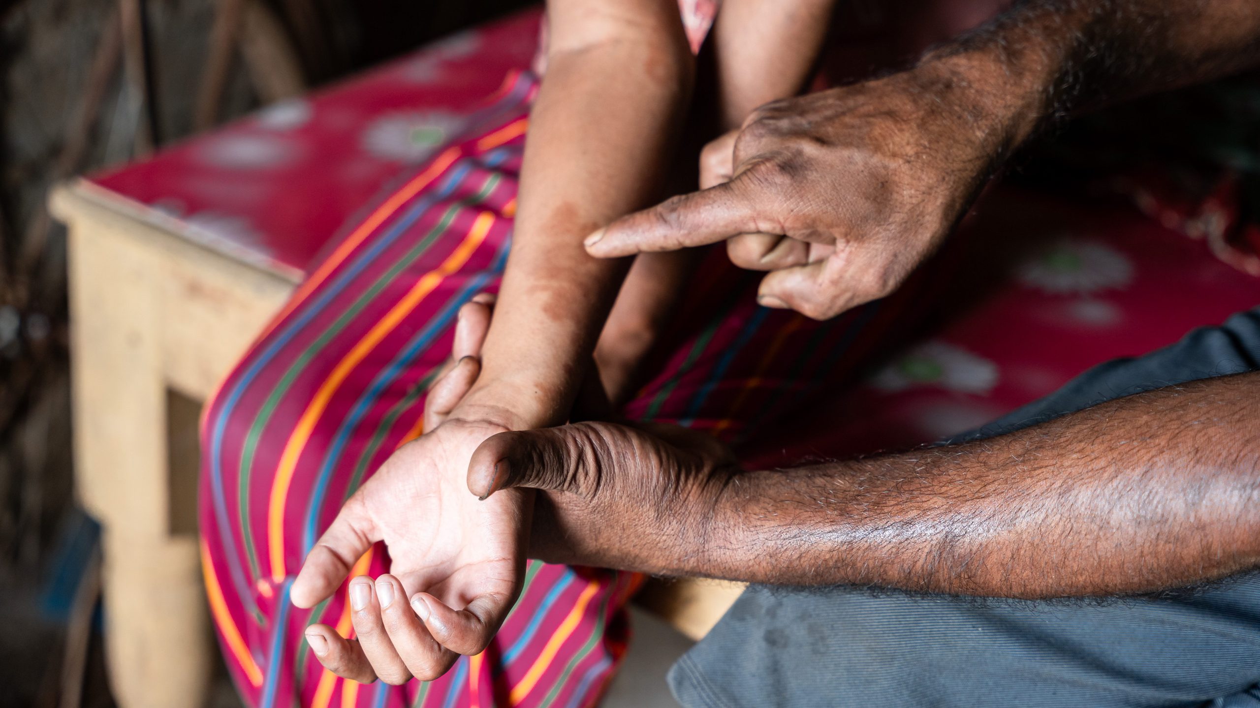 A close-up of a child’s arm showing light patches on the skin.