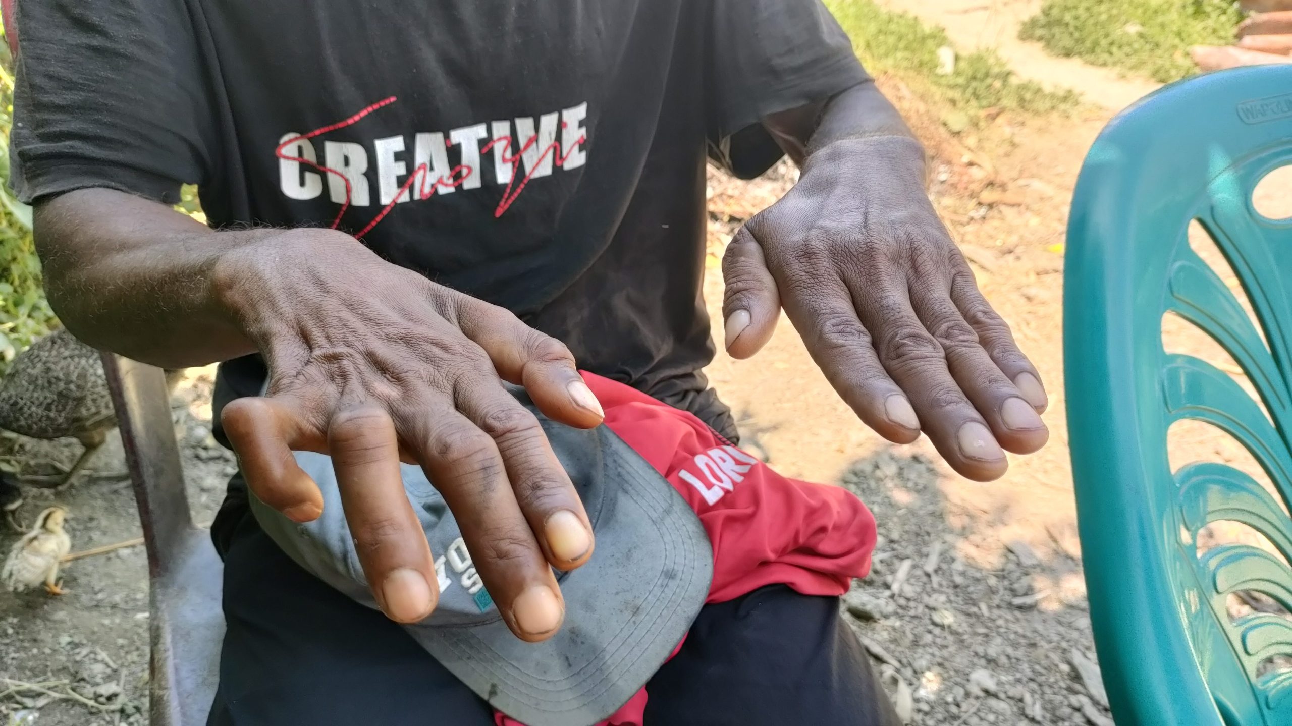Hands of a person affected by leprosy in Timor-Leste.