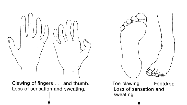 "Levels of impairment that can occur - Level 1" - line drawings from Jean Watson's writing. Source: Essential Action to Minimise Disability in Leprosy Patients by Jean M Watson